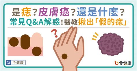 痣多的原因|是痣？皮膚癌？還是什麼？常見Q&A解惑！醫教揪出「。